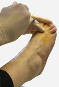 Cortisone-Injection-into-2nd-MTPJ1