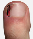 ingrown toenail