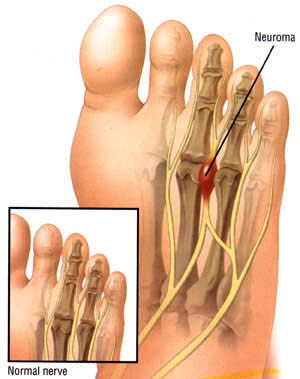 Mortons Neuroma Treatment