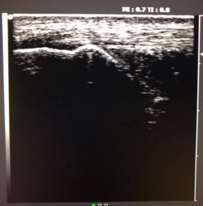 Achilles tendon Ultrasound (1)