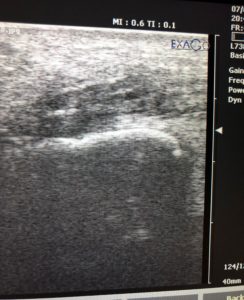 Achilles tendon Ultrasound