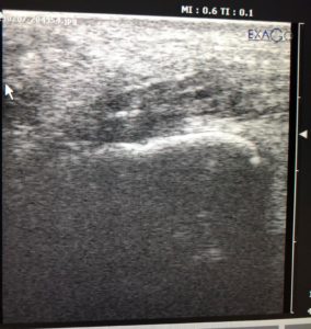 Achilles tendon Ultrasound