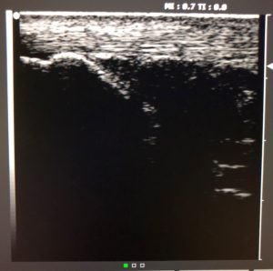 Achilles tendon Ultrasound