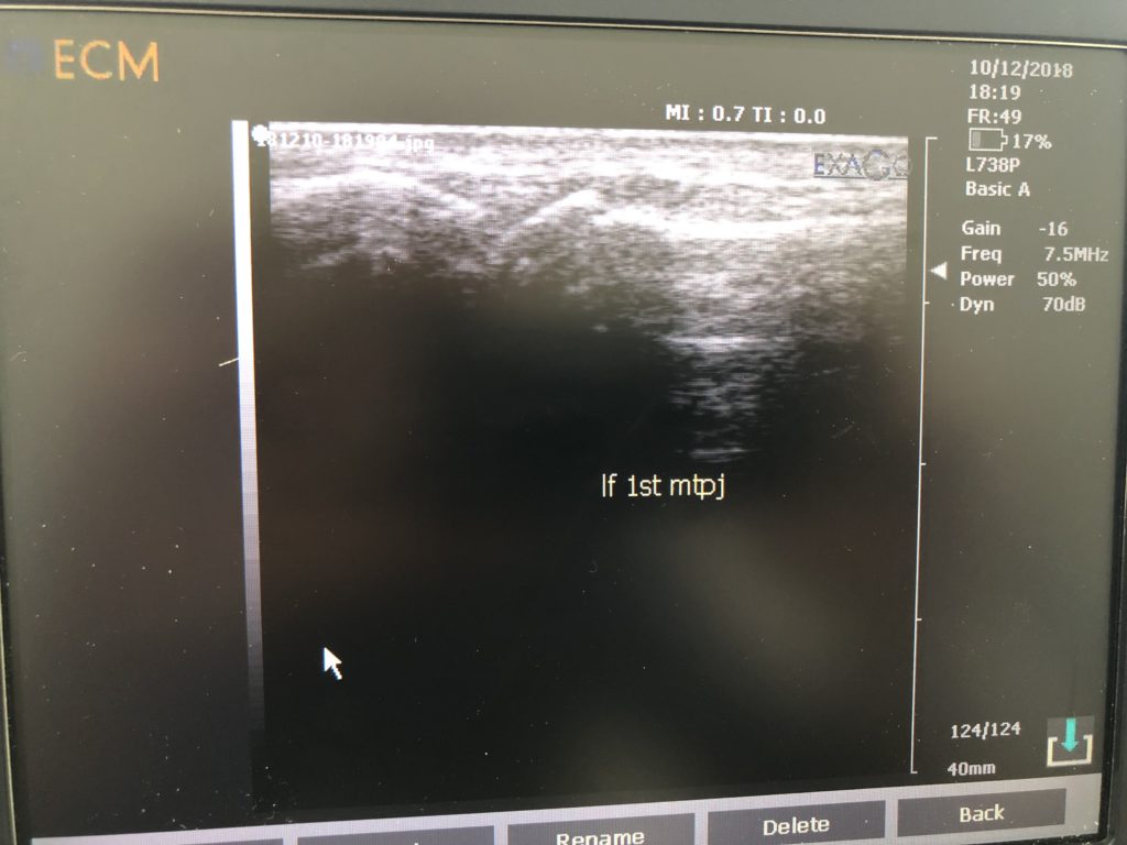 Foot pain ultrasound