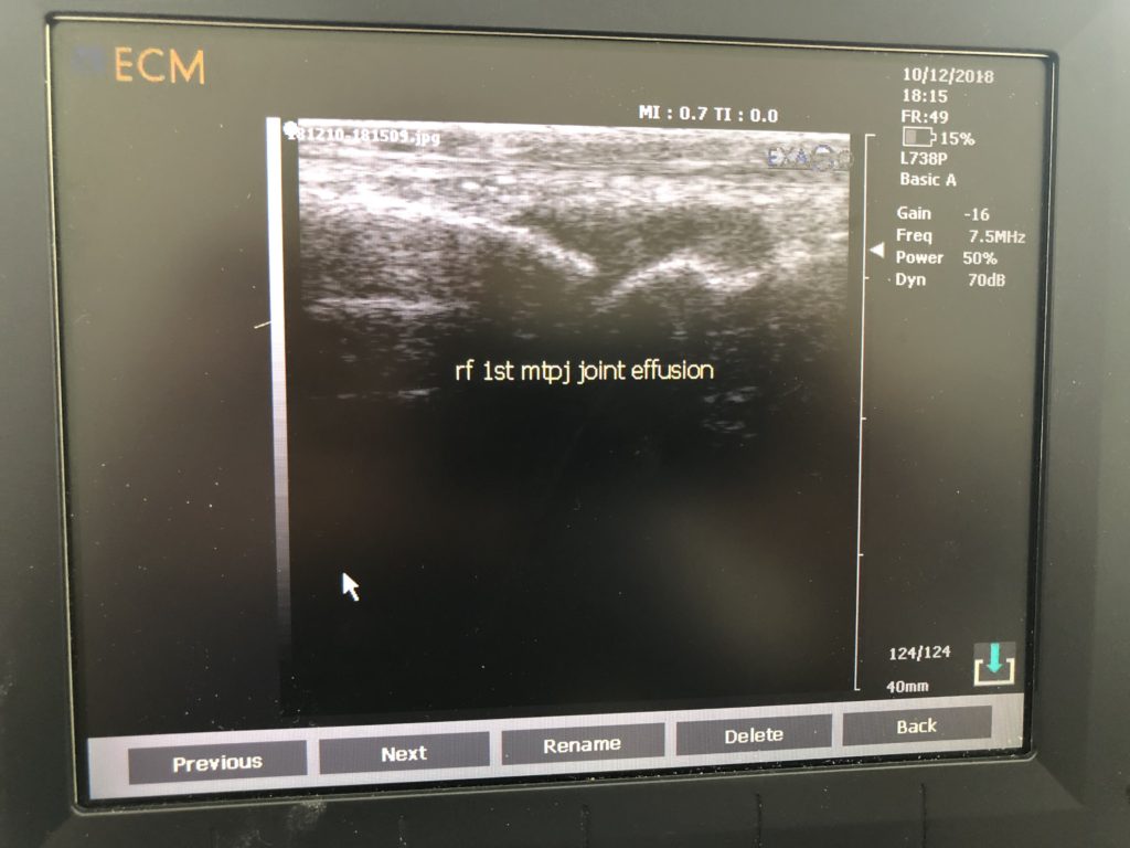 Foot pain ultrasound