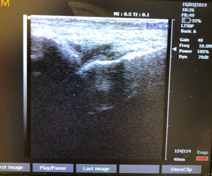 Ultrasound showing selling on the big toe joint