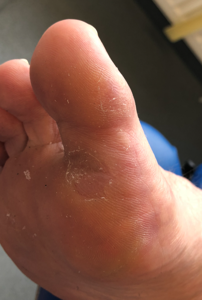 Dry needling treatment