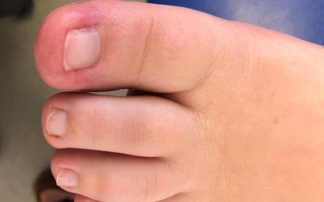 Ingrown toenail