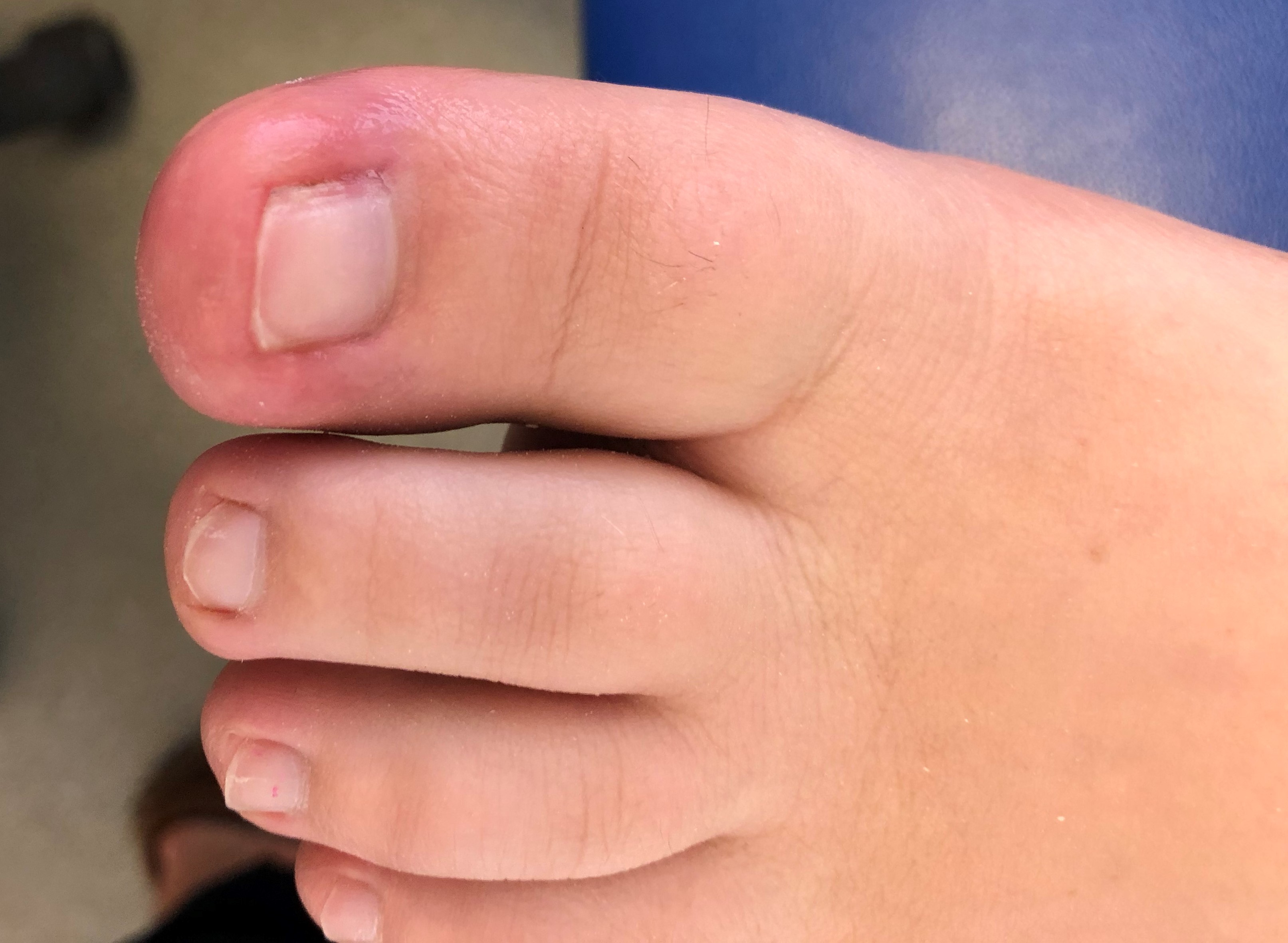 Ingrown toenail