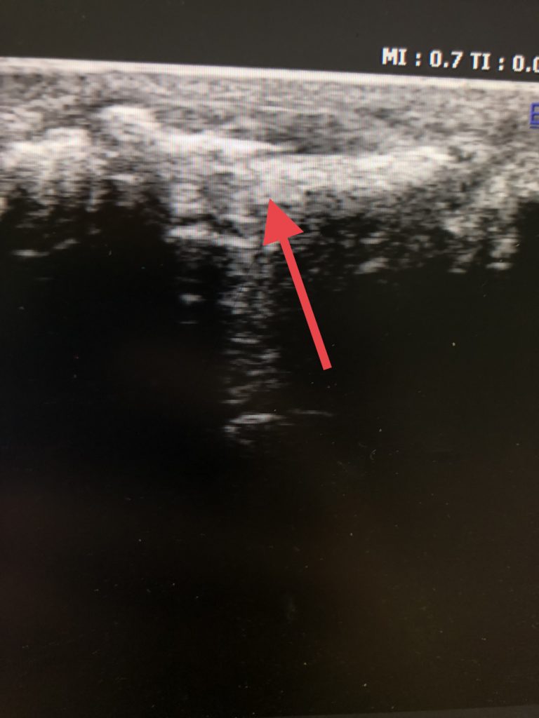 ultrasound of a broken toe