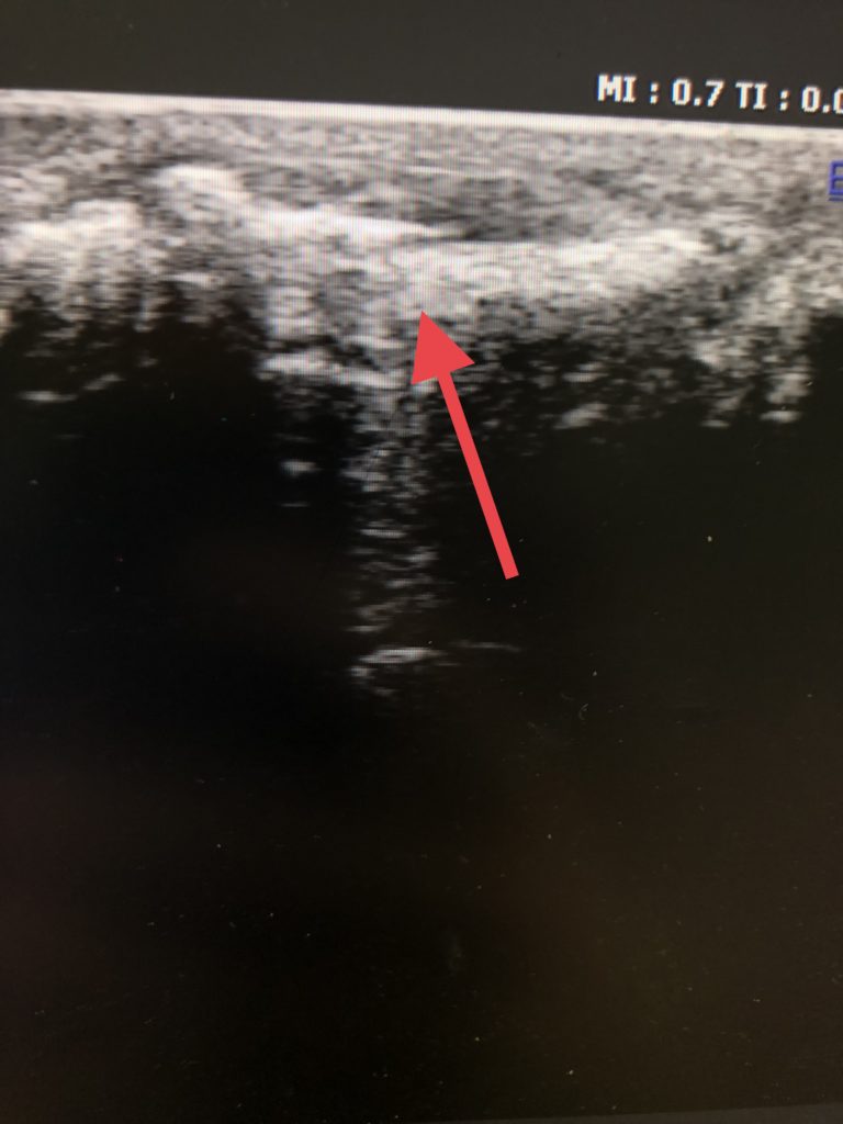 ultrasound of a broken toe