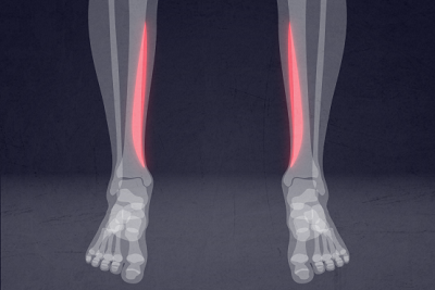 Shin splints