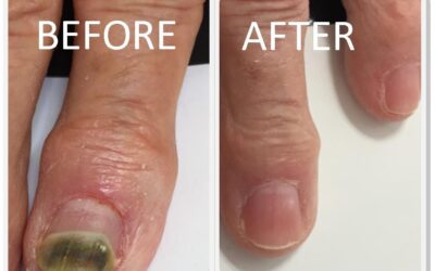 What is the most effective fungal nail treatment?