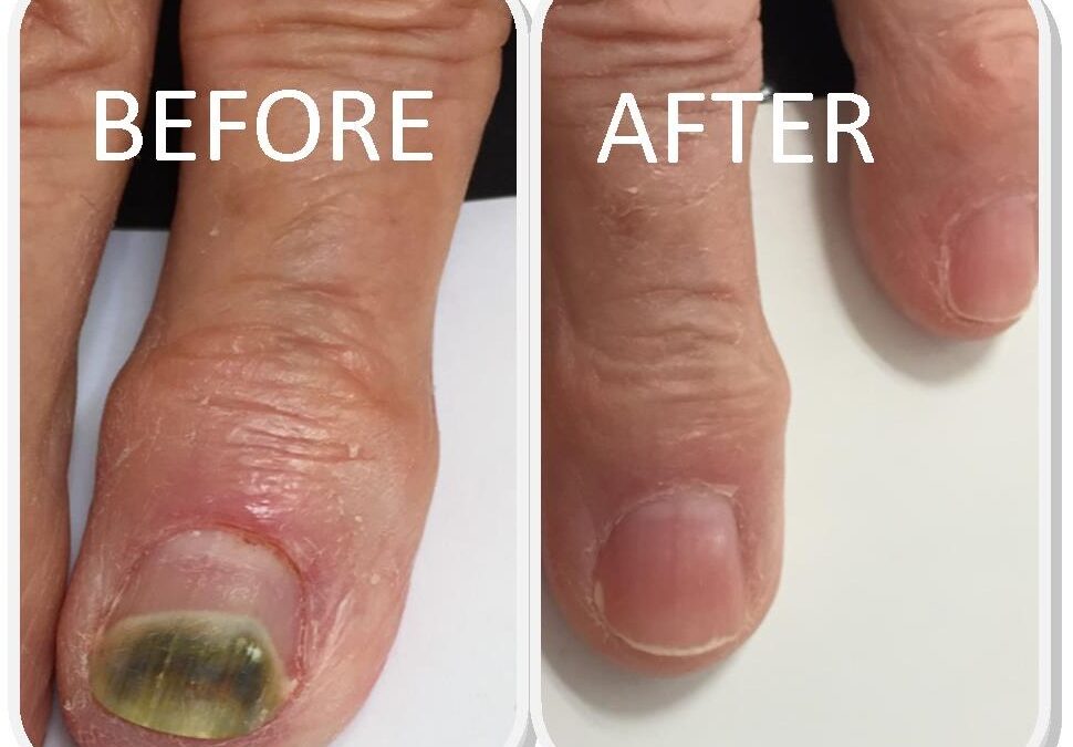 What is the most effective fungal nail treatment?