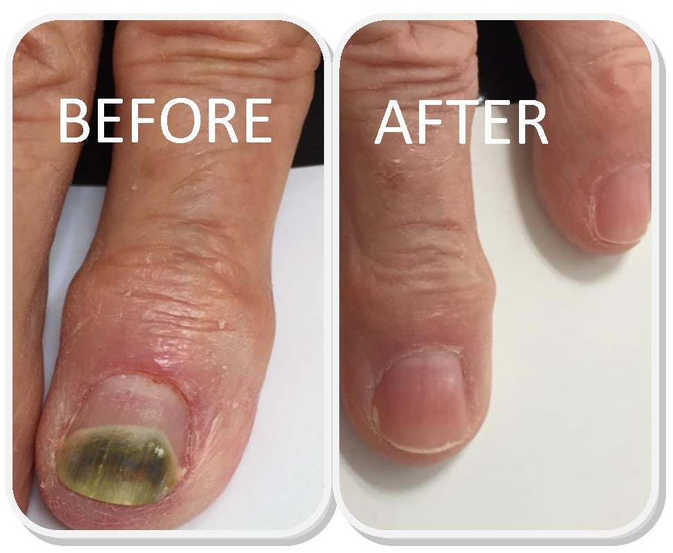 Fungal nail infection: Overview, Causes, Types & Treatment - Medinaz -  Medinaz Blog