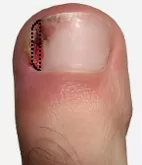 ingrown toenail