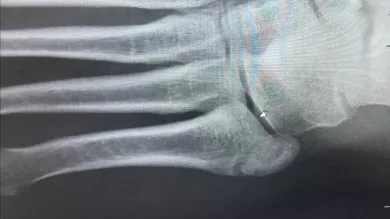 Stress Fracture