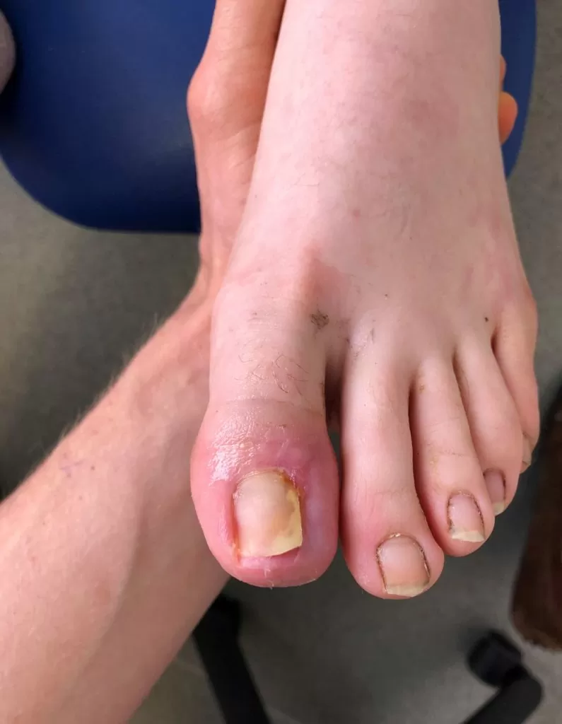 Toenail post partial nail avulsion