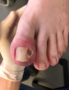 Ingrown toenail