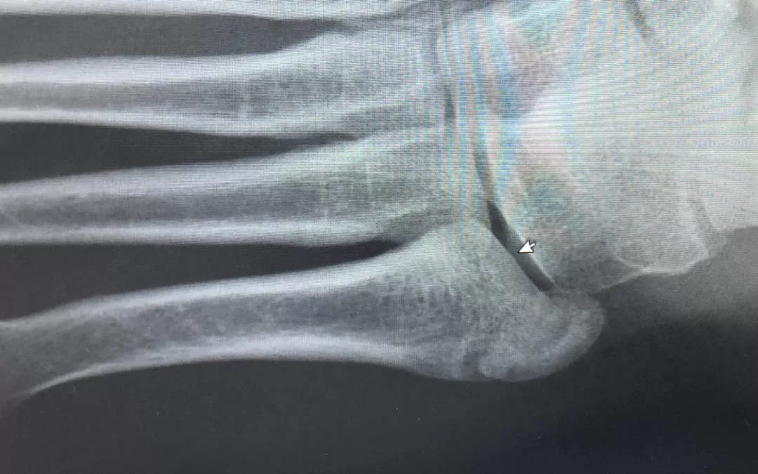 Stress Fracture