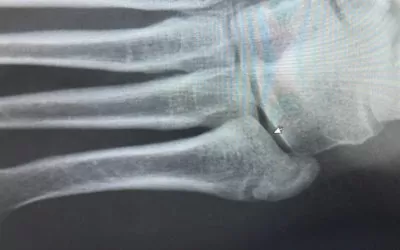 Diagnosing A Stress Fracture With Ultrasound